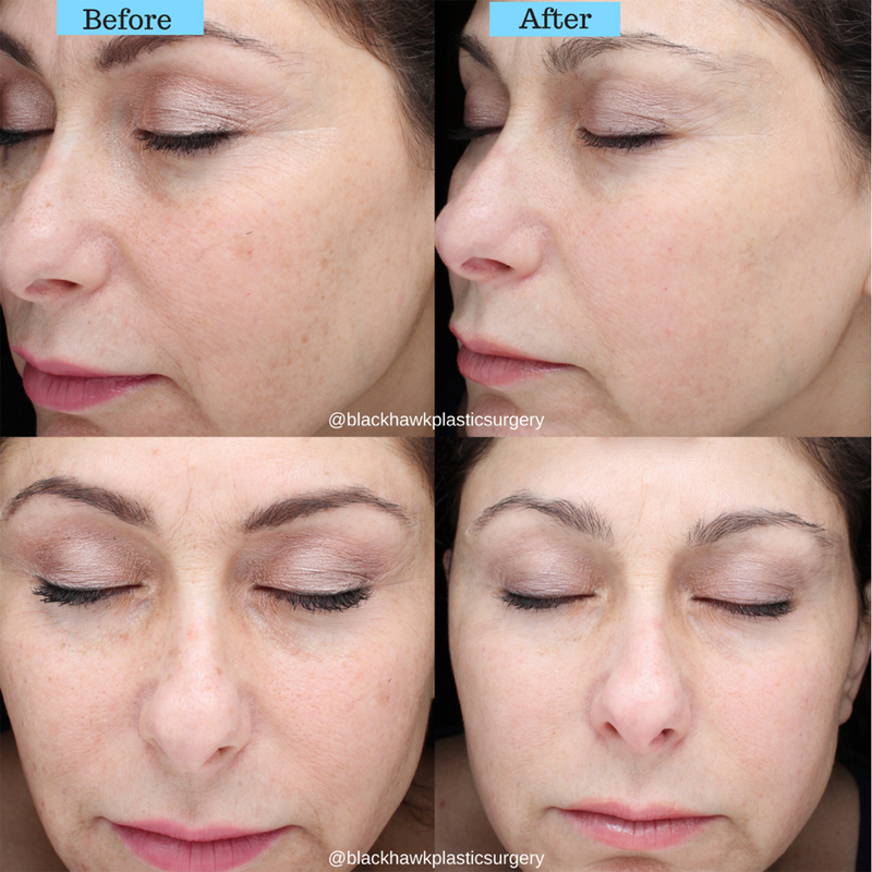 Brown spots removal before & After
