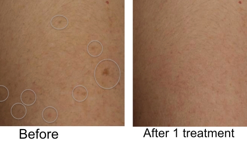 Brown spots removal before & After