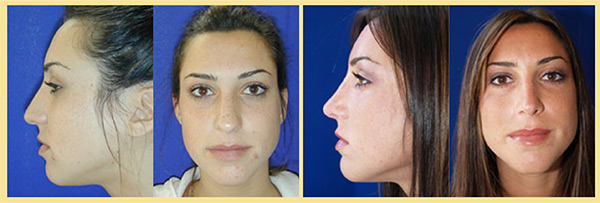Rhinoplasty & Nose Job Surgeon | Before & After | Dr. Ronan