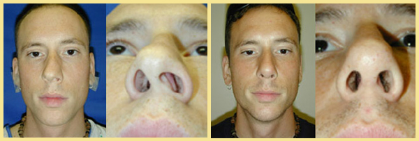 Nose Job Surgeon | Before & After | Dr. Ronan