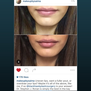 Lip Augmentation Before & after