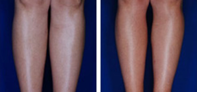 Calf/Ankle Liposuction
