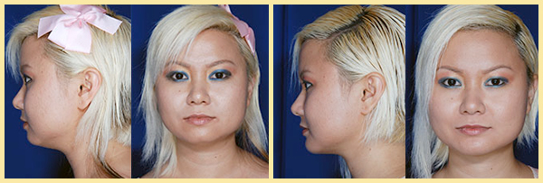 Chin Implant Before & After