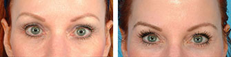 Eyebrow Transplants Before & After