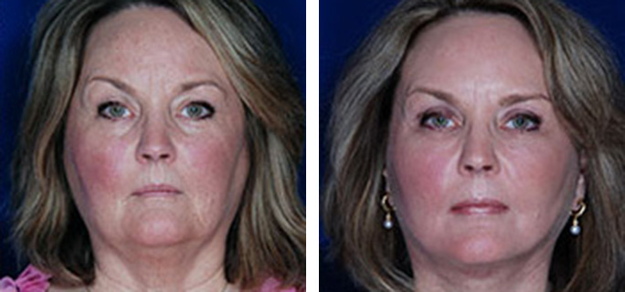 Facial Fat Transfer Before & After