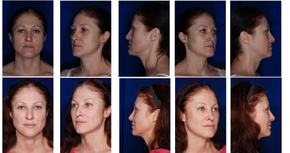 Skin Resurfacing Before & After