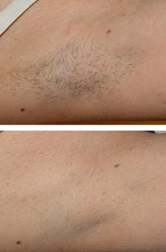 Laser Hair Removal Before & After