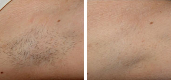 Laser Hair Removal Before & After