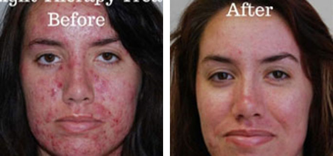 Light Therapy Before & After