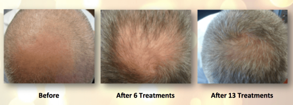 Light Therapy For Hair Growth Before & After