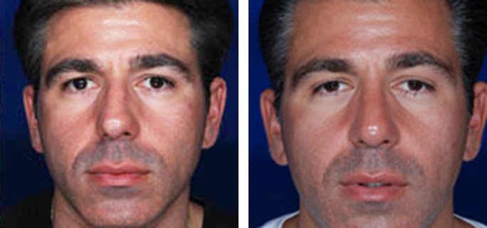Male Rhinoplasty & Nose Job Surgery Before & After Photos | Dr. Ronan
