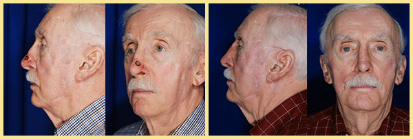 Skin Cancer Reconstruction Before & After