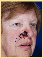 Skin Cancer Reconstruction Before & After