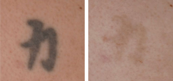 Tattoo Removal Before & After