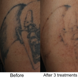 Tattoo Removal Before & After