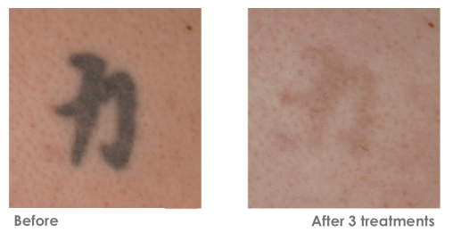 Tattoo Removal Before & After