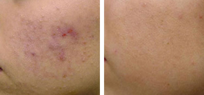Vivace Micro Needle Before & After